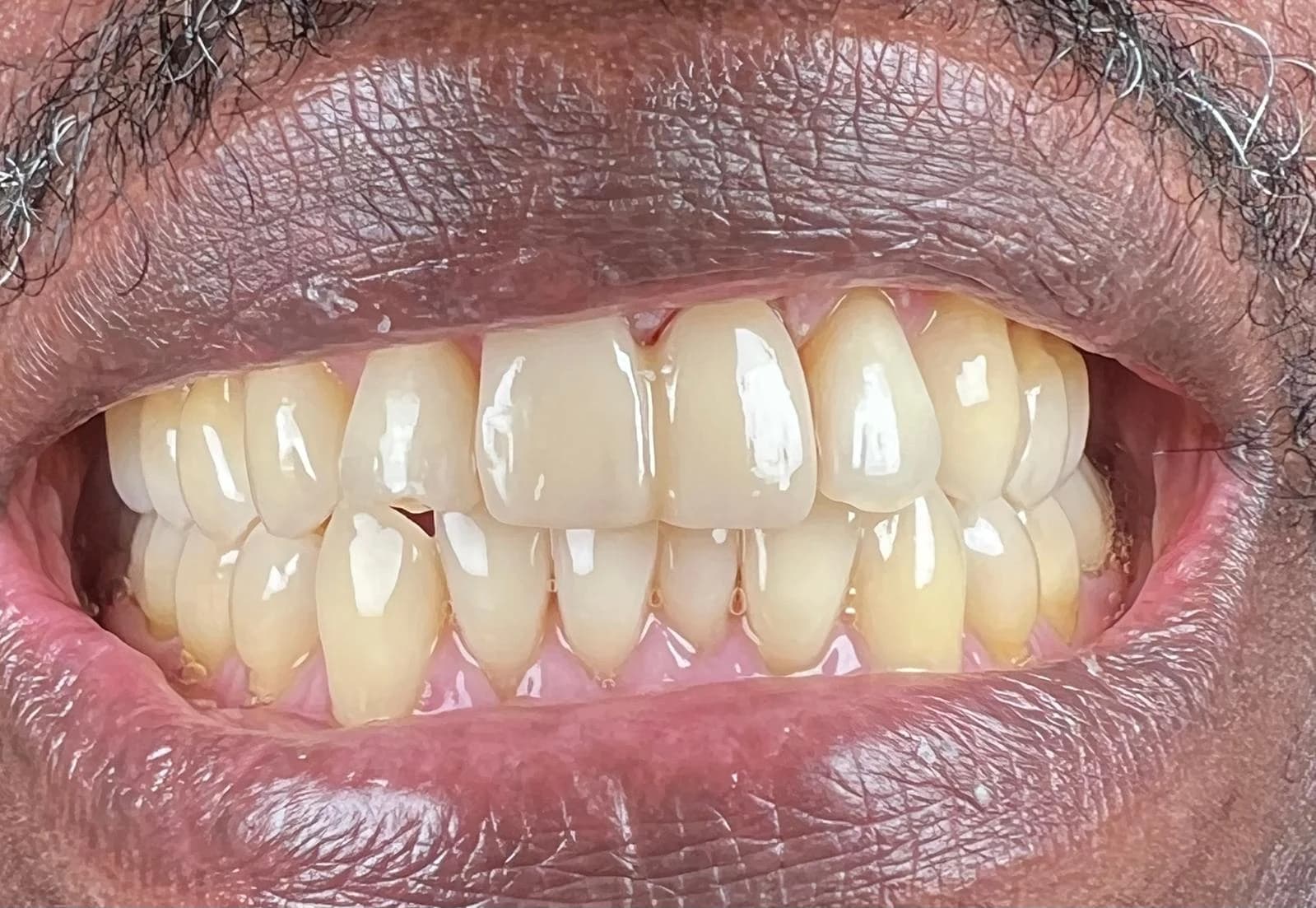 Glimlach van een patiënt na een esthetische spoedreparatie op dezelfde dag bij Dentacare Osdorp.