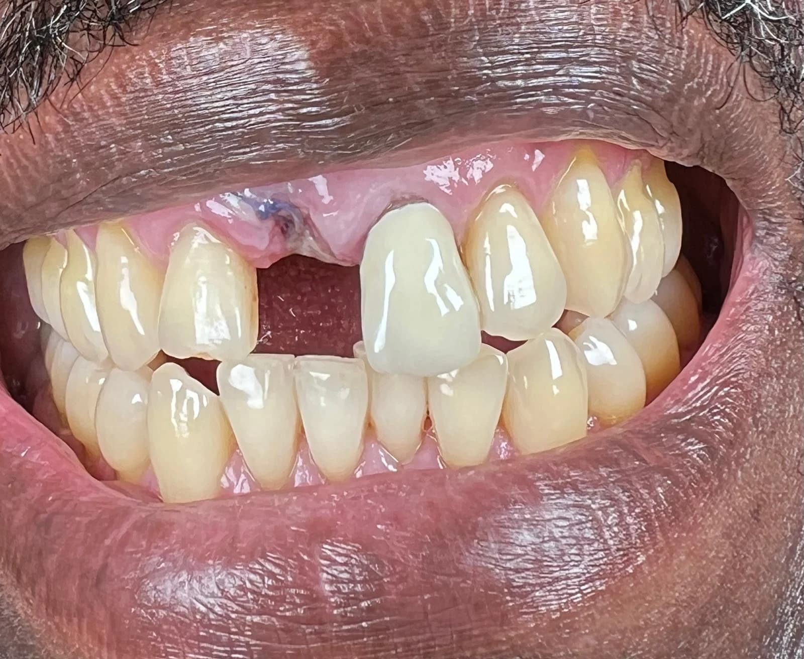 Glimlach van een patiënt vóór een esthetische spoedreparatie op dezelfde dag bij Dentacare Osdorp.