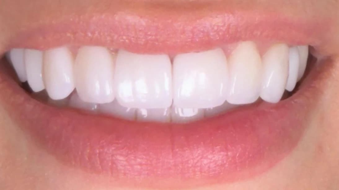 Porseleinen Veneers: Gebit van patiënt na de behandeling bij Dentacare Osdorp.