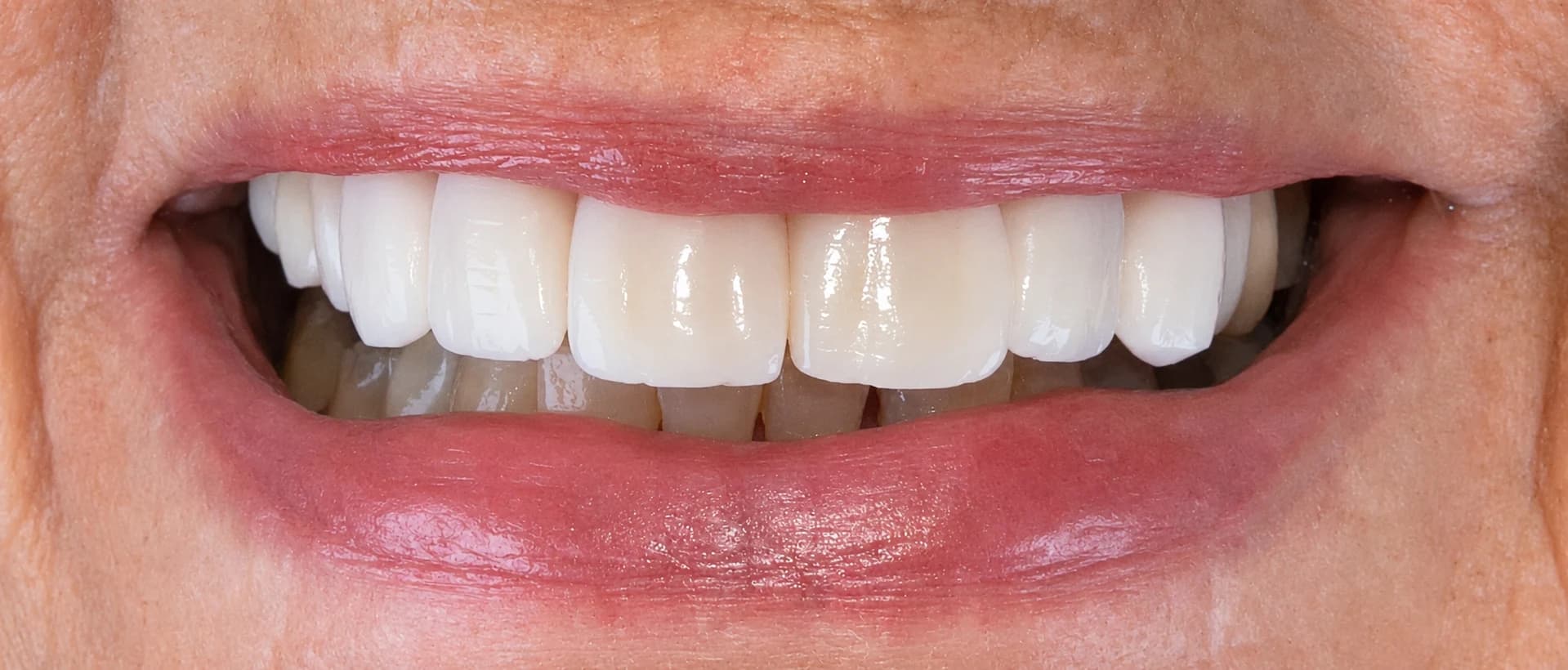 Porseleinen Veneers: Gebit van patiënt na de behandeling bij Dentacare Osdorp.