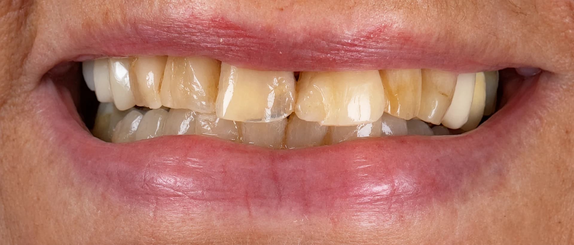 Porseleinen Veneers: Gebit van patiënt voor de behandeling bij Dentacare Osdorp.