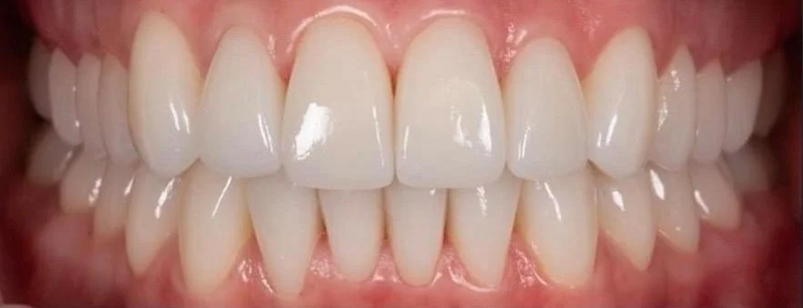 Gebit van patiënt na de behandeling bij Dentacare Osdorp.