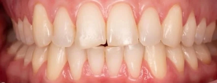 Gebit van patiënt voor de behandeling bij Dentacare Osdorp.