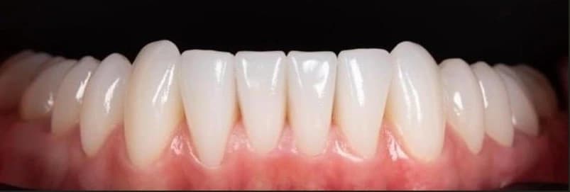 Porseleinen Veneers: Gebit van patiënt na de behandeling bij Dentacare Osdorp.