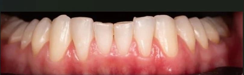 Porseleinen Veneers: Gebit van patiënt voor de behandeling bij Dentacare Osdorp.