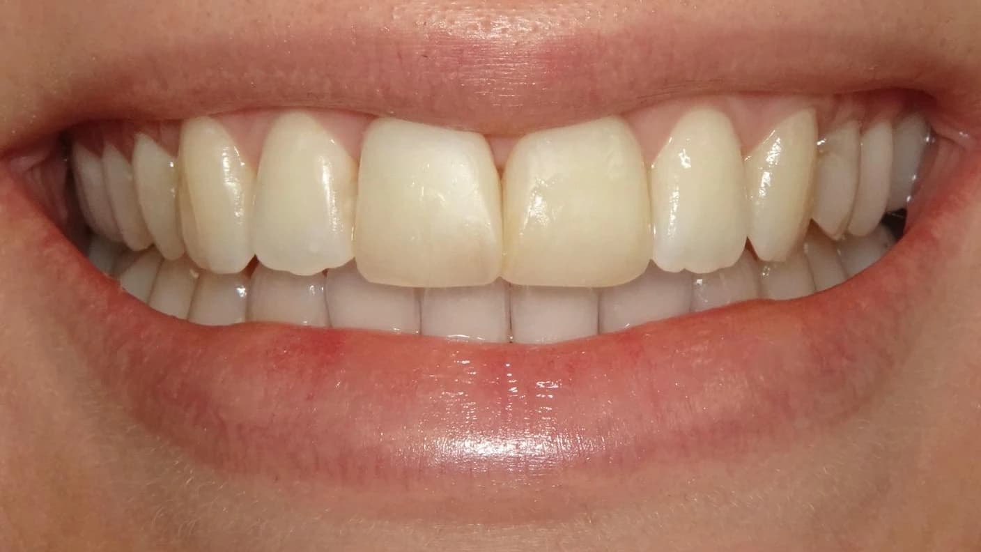 Glimlachrehabilitatie: Glimlach van patiënt voor de behandeling bij Dentacare Osdorp.