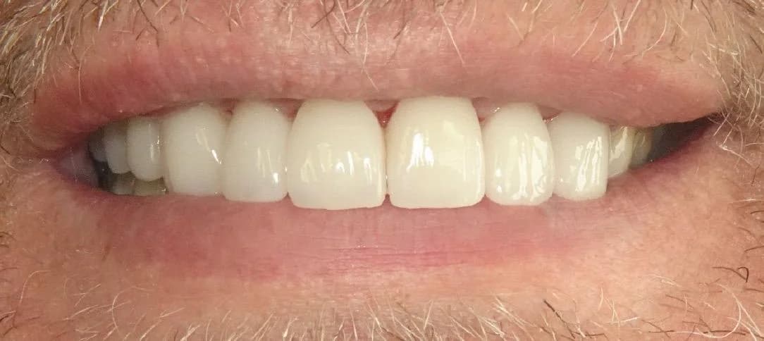 Porseleinen Veneers: Glimlach van patiënt na de behandeling bij Dentacare Osdorp.