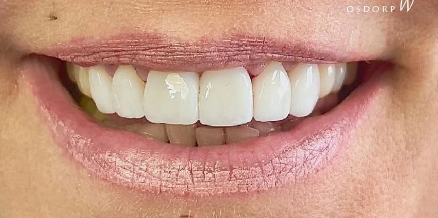 Porseleinen Veneers: Glimlach van patiënt na de behandeling bij Dentacare Osdorp.