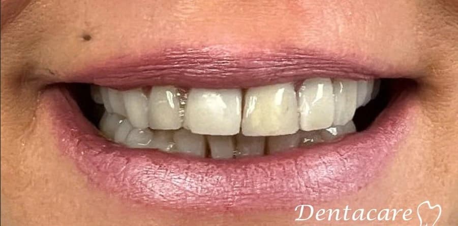 Porseleinen Veneers: Glimlach van patiënt voor de behandeling bij Dentacare Osdorp.