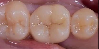 Tandkroon: Kies van patiënt na de kroonbehandeling bij Dentacare Osdorp.