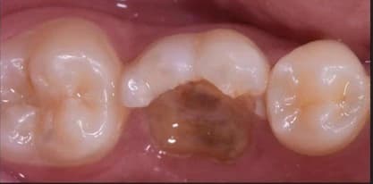 Tandkroon: Beschadigde kies van patiënt voor de kroonbehandeling bij Dentacare Osdorp.