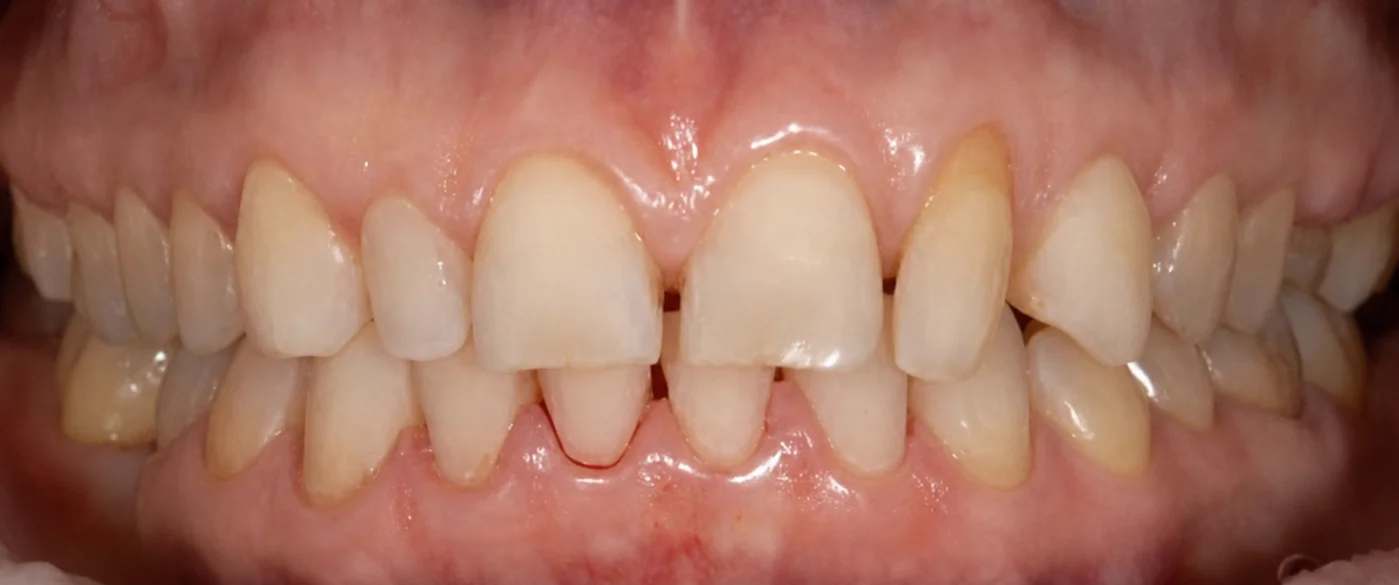 Porseleinen Veneers: Glimlach van patiënt voor de tandheelkundige behandeling.
