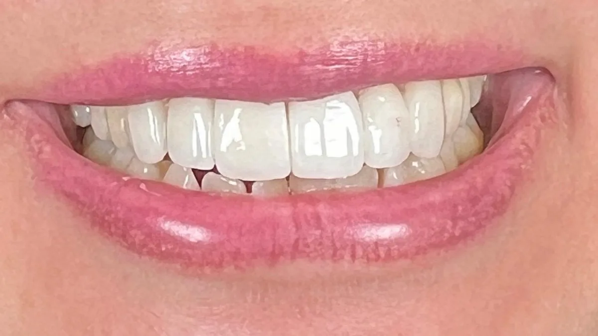 Porseleinen Veneers: Glimlach van patiënt na de behandeling bij Dentacare Osdorp.