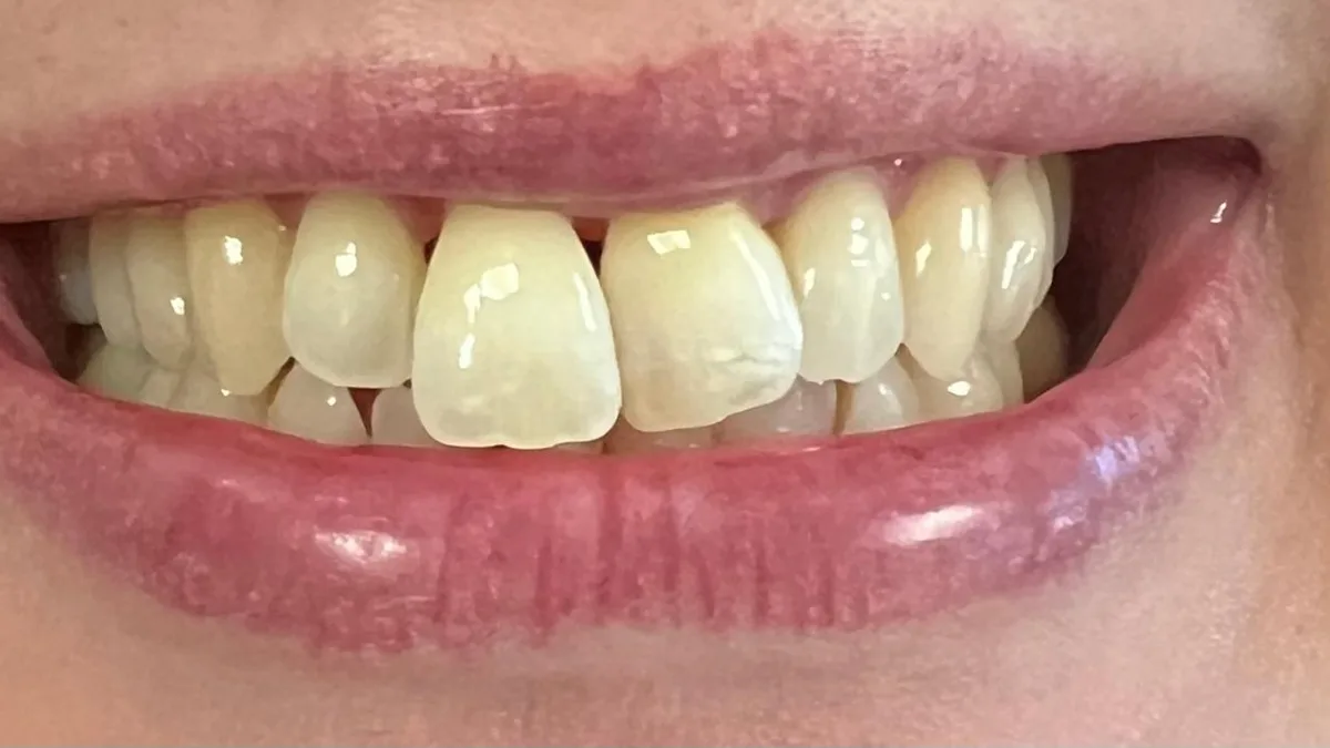 Porseleinen Veneers: Glimlach van patiënt voor de behandeling bij Dentacare Osdorp.