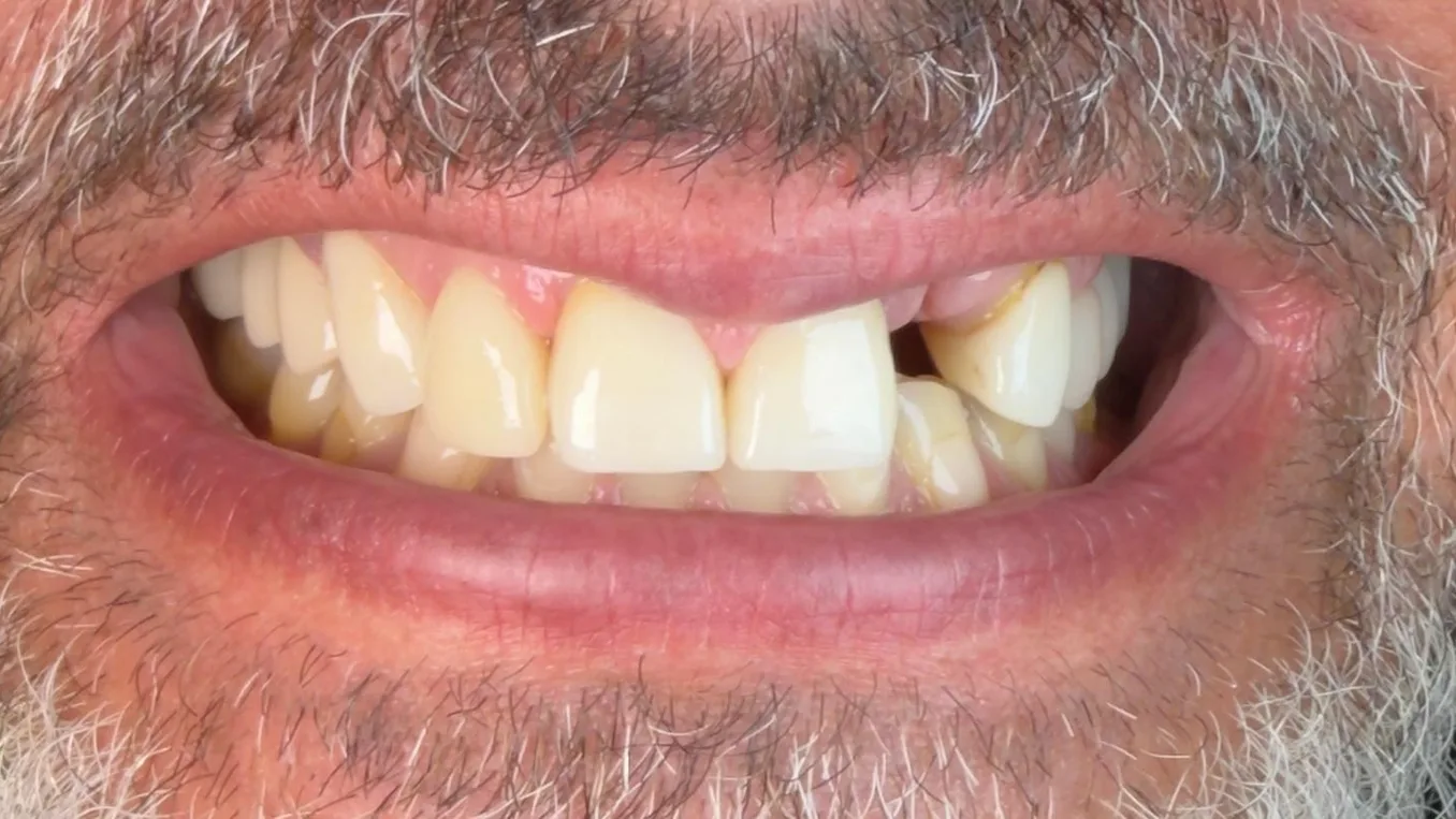 Kroonrestauratie: Beschadigde voortand van patiënt voor de kroonbehandeling bij Dentacare Osdorp.