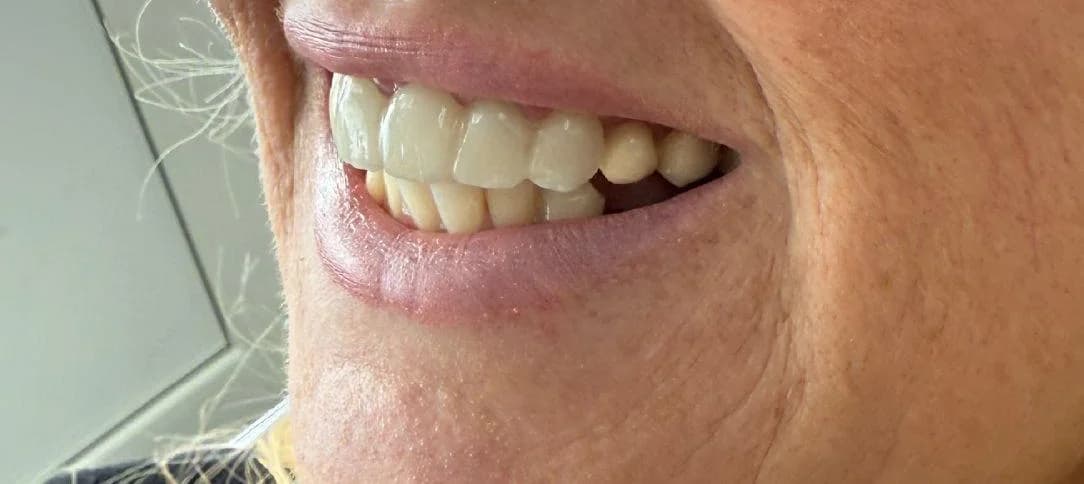 Glimlachrehabilitatie: Glimlach van patiënt na de behandeling bij Dentacare Osdorp.