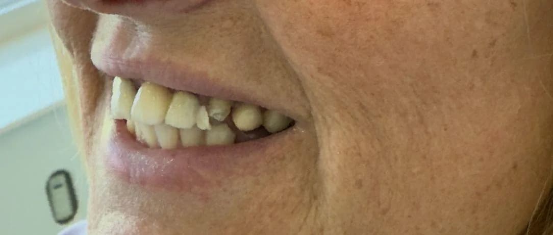 Glimlachrehabilitatie: Glimlach van patiënt voor de behandeling bij Dentacare Osdorp.
